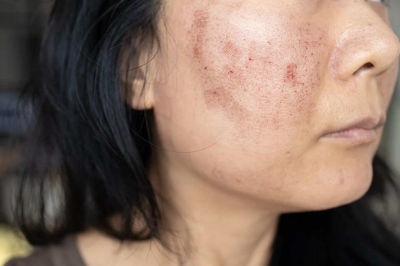 Crystal Glow IV for dull and pigmented skin brightening