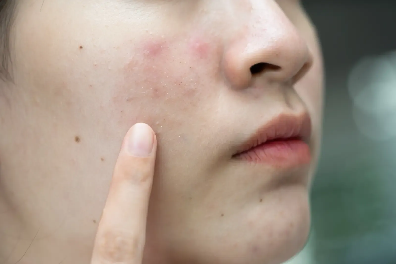 Face PRP for adults 25-40 with early ageing and dull skin