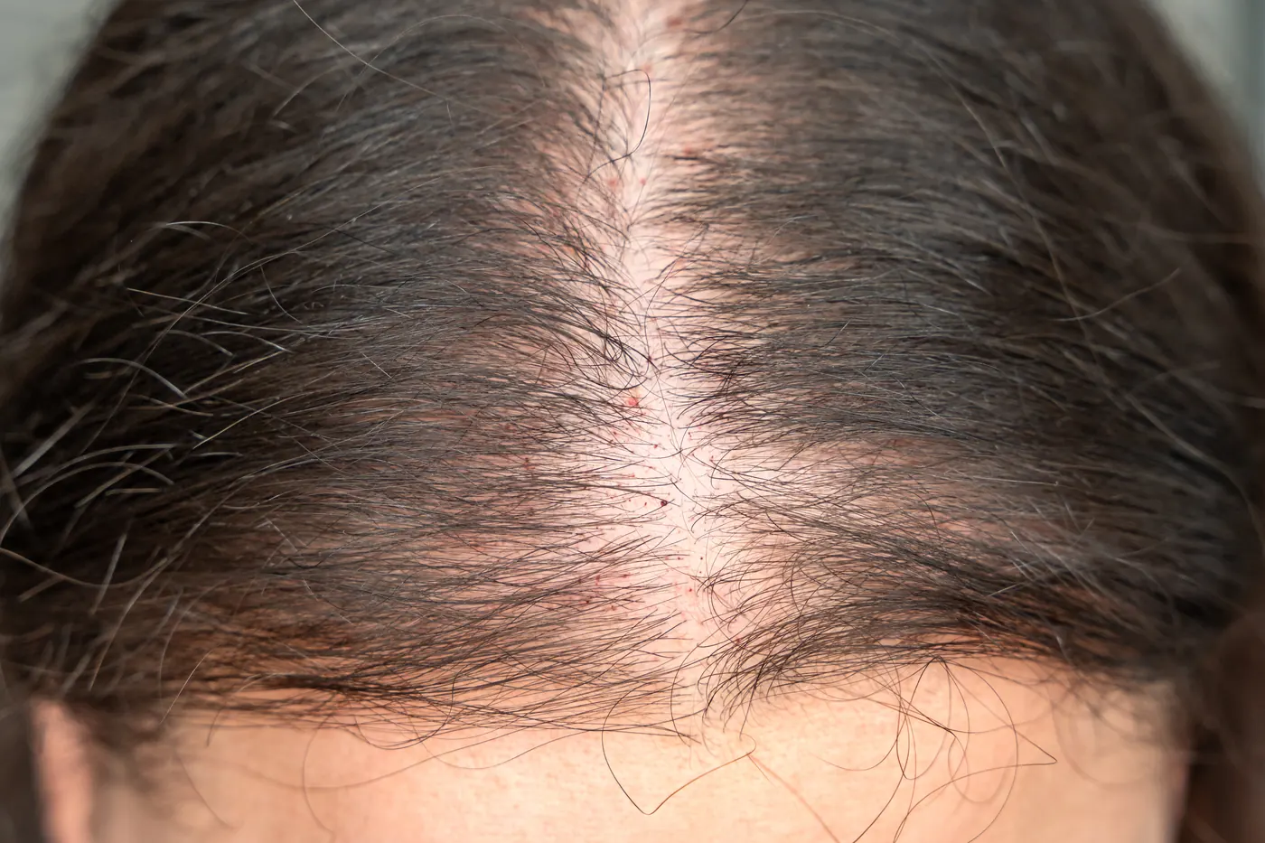 Hair PRP for men with early-to-moderate hair thinning
