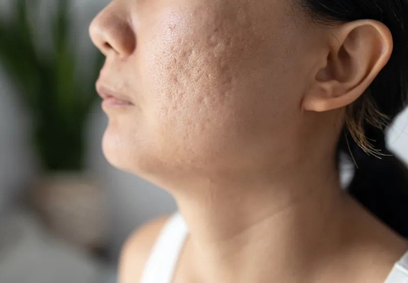 Acne Scars